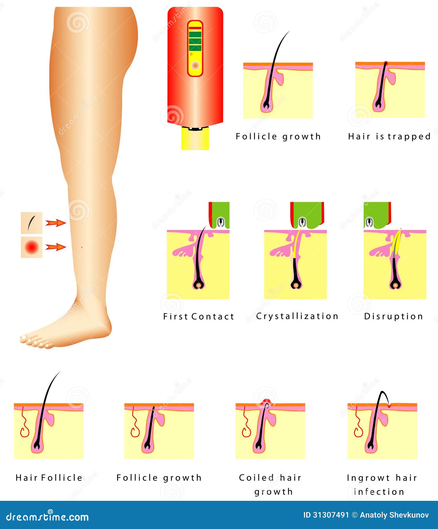 pubic hair infection