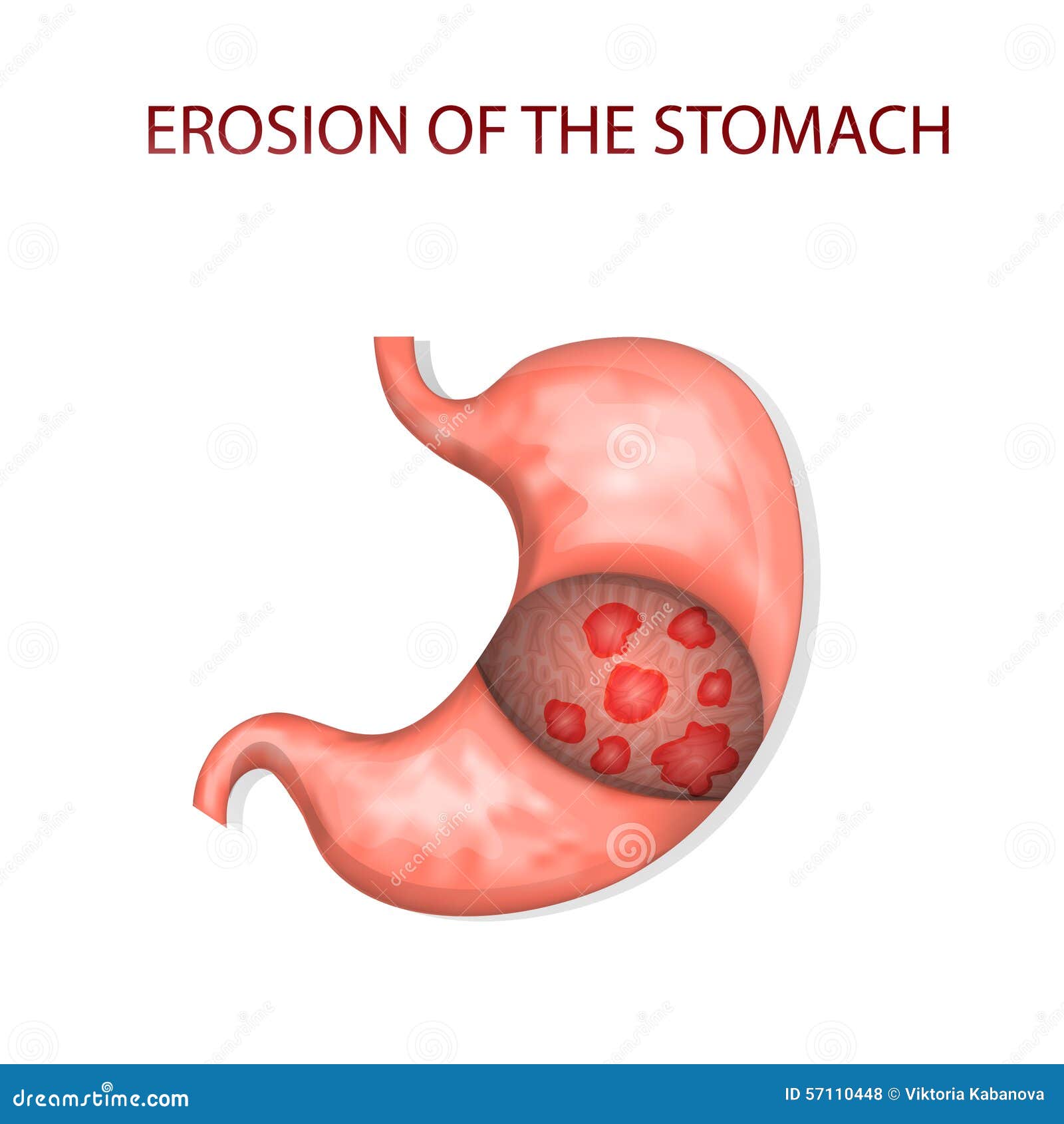 Albums 99+ Images erosion of the protective layer of the stomach Superb
