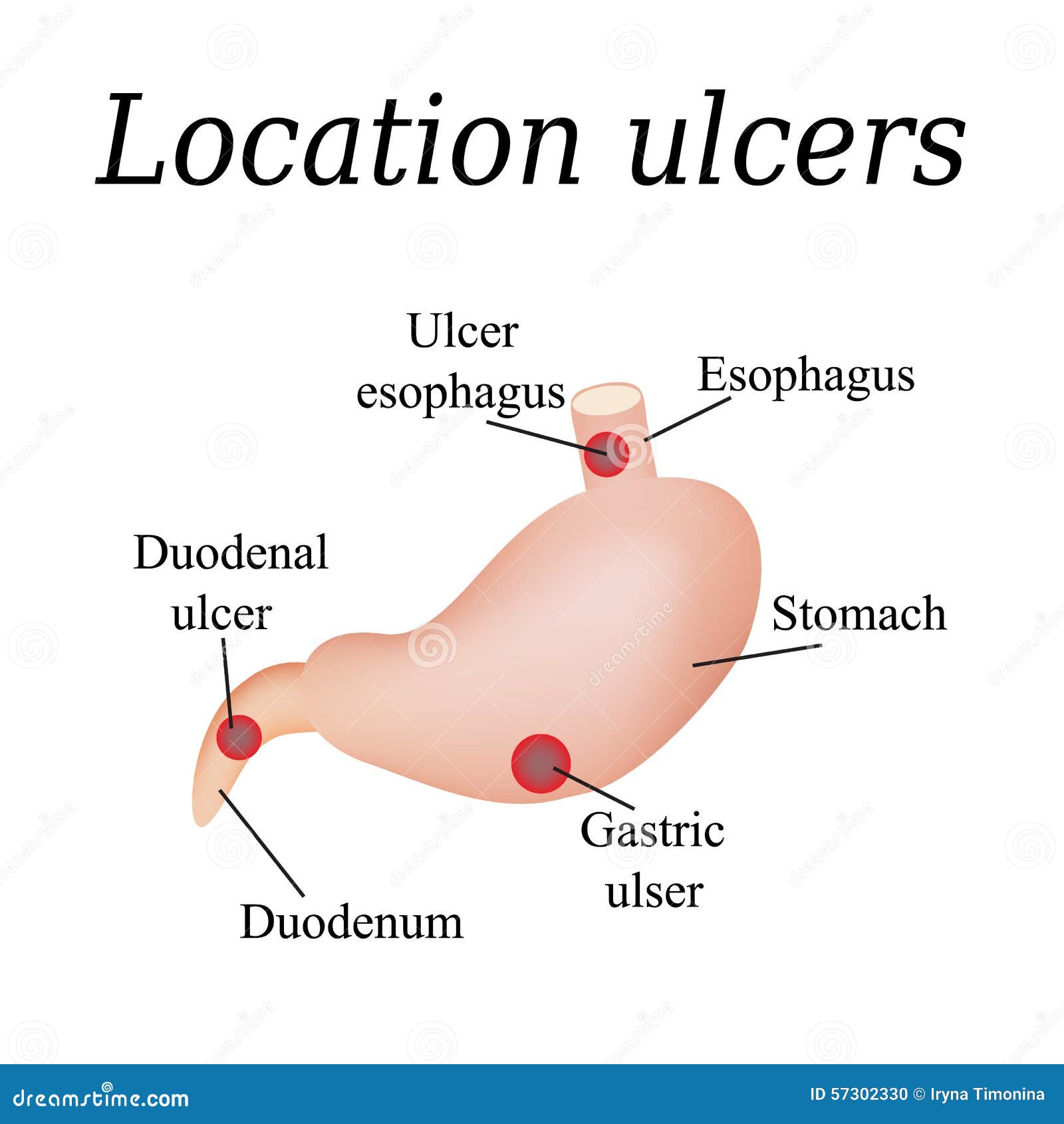 Peptic Ulcer Cartoons  Illustrations  U0026 Vector Stock Images