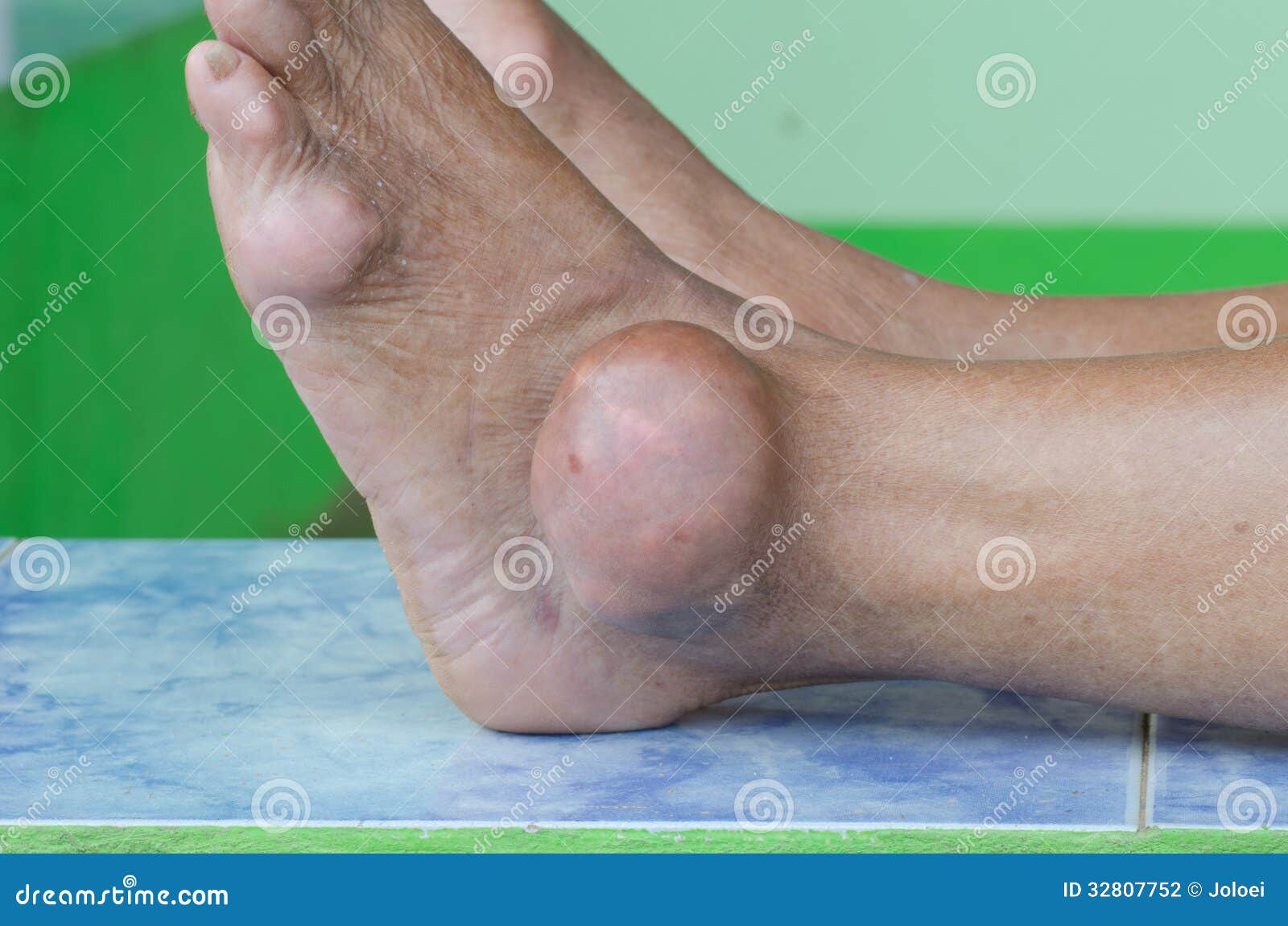 gout foot pictures