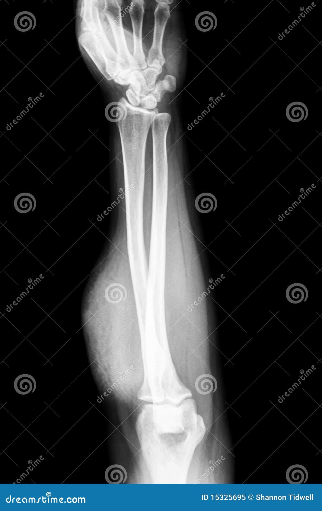 Forearm X-ray Royalty Free Stock Photo - Image: 15325695