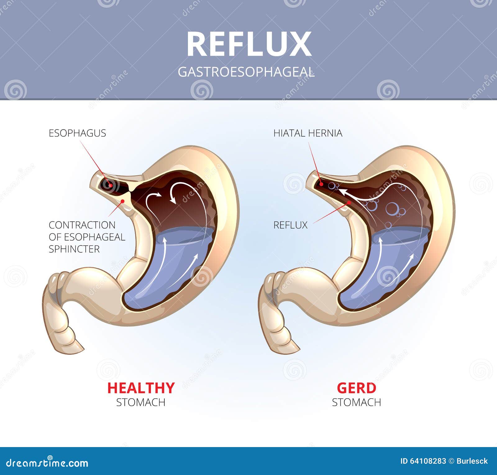 Gastroesophagea...