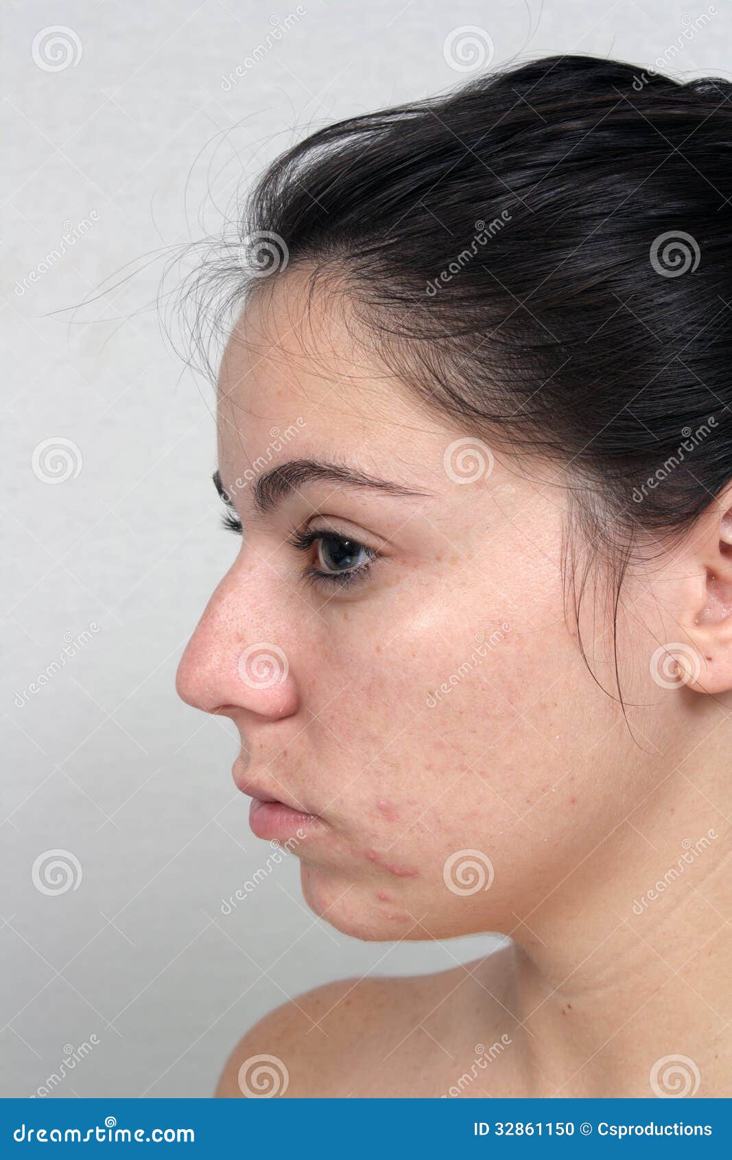 acne in young adult women acne in young adult women