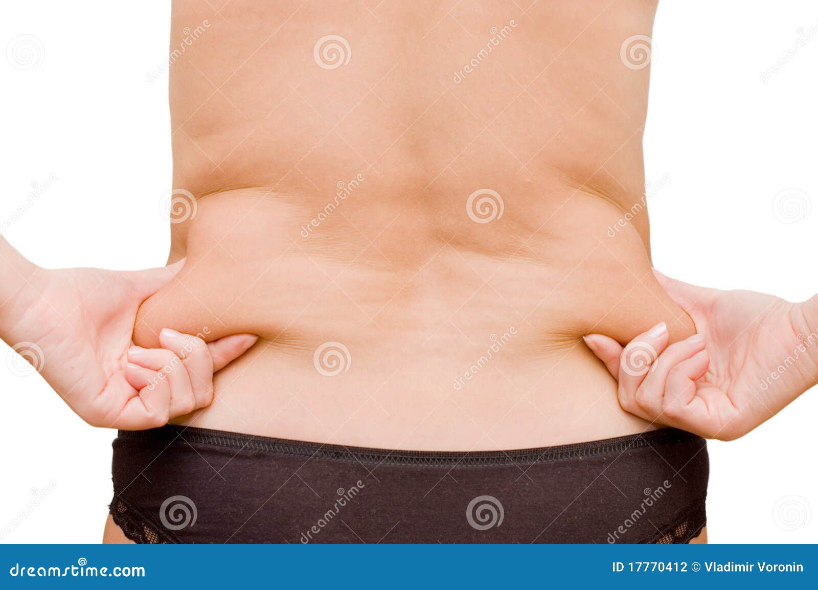 cellulitis stomach #9