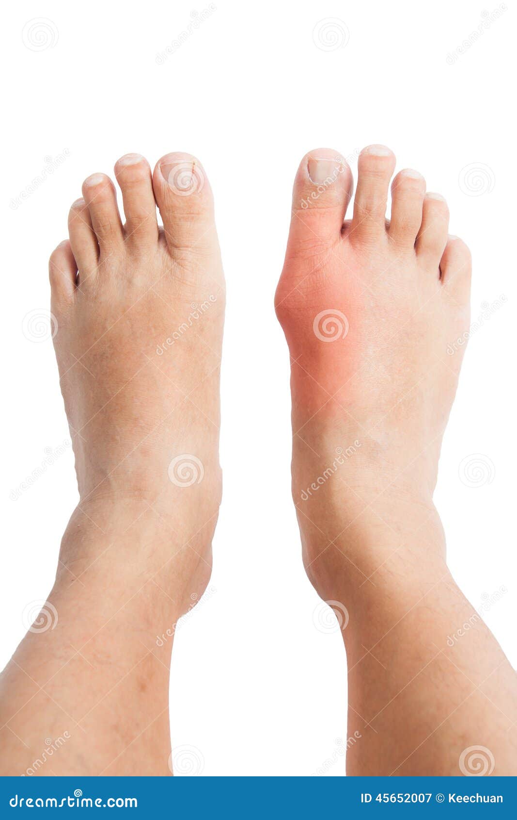 Hammertoe