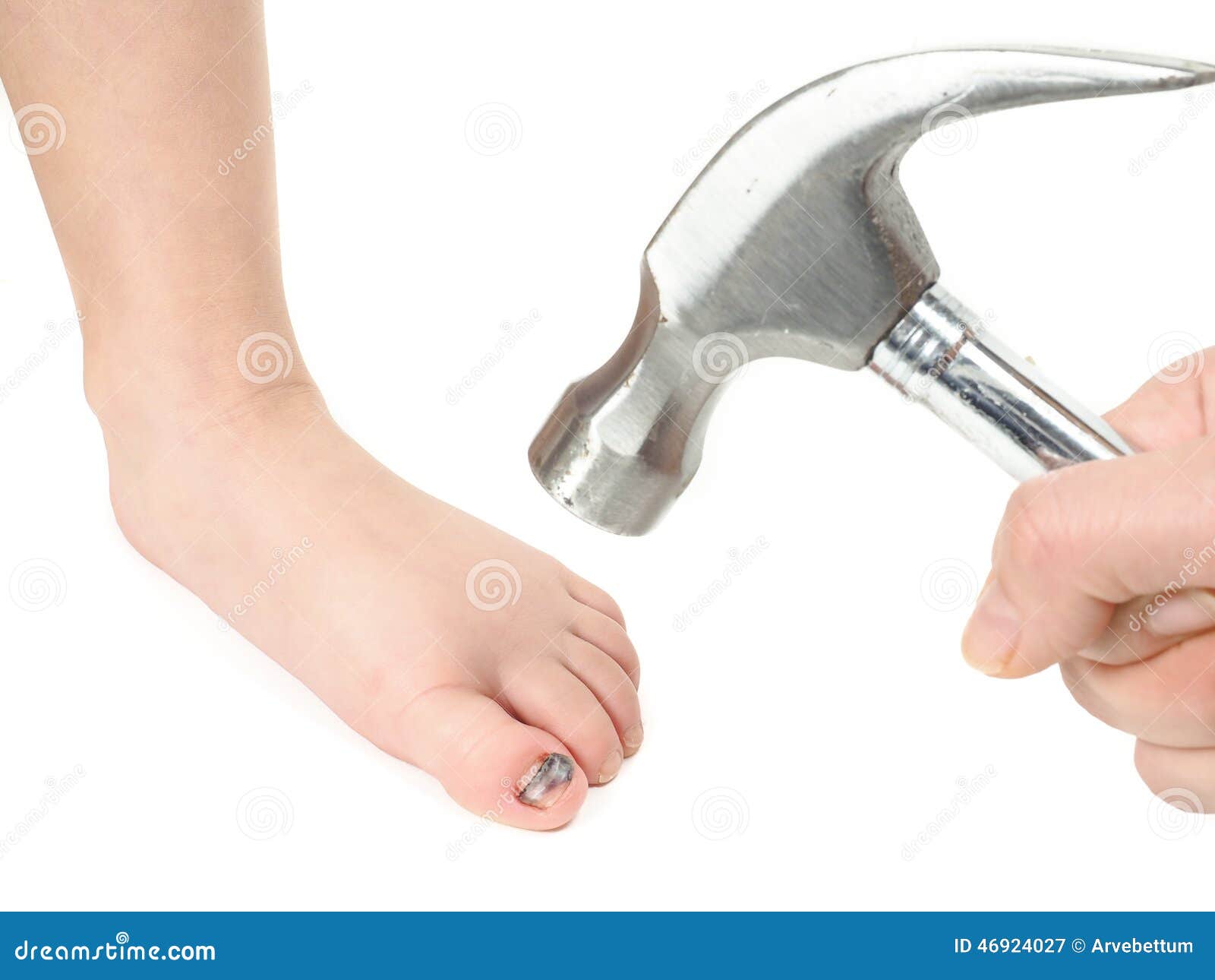 Hammertoe