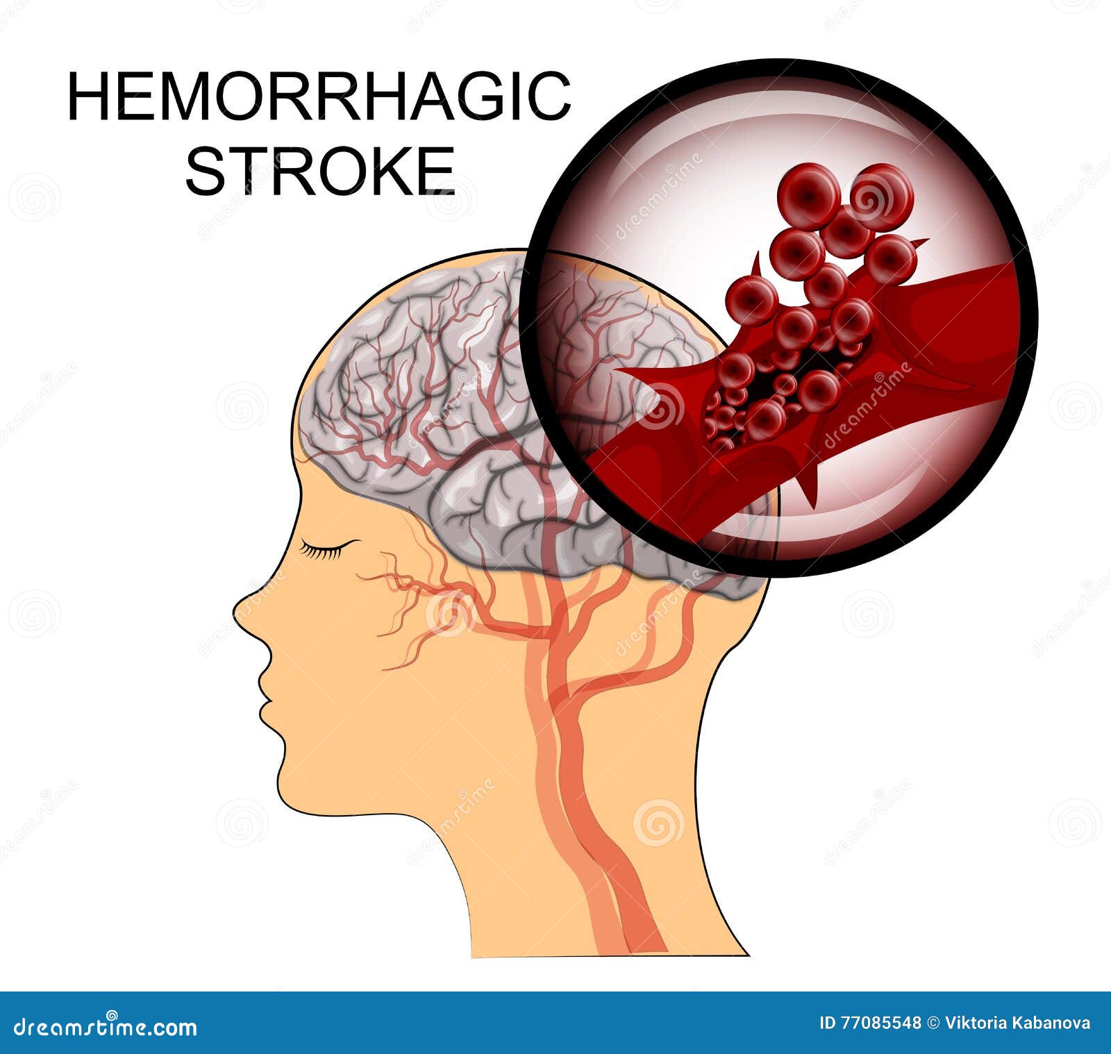 ischemic stroke early symptoms tia signs blood pressure