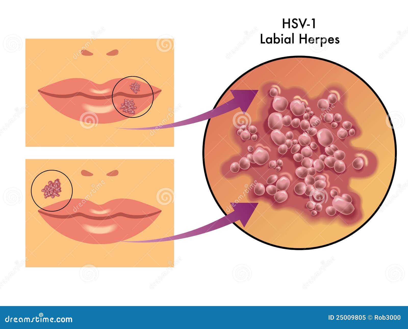 Herpes Simplex Picture - Herpes Pictures