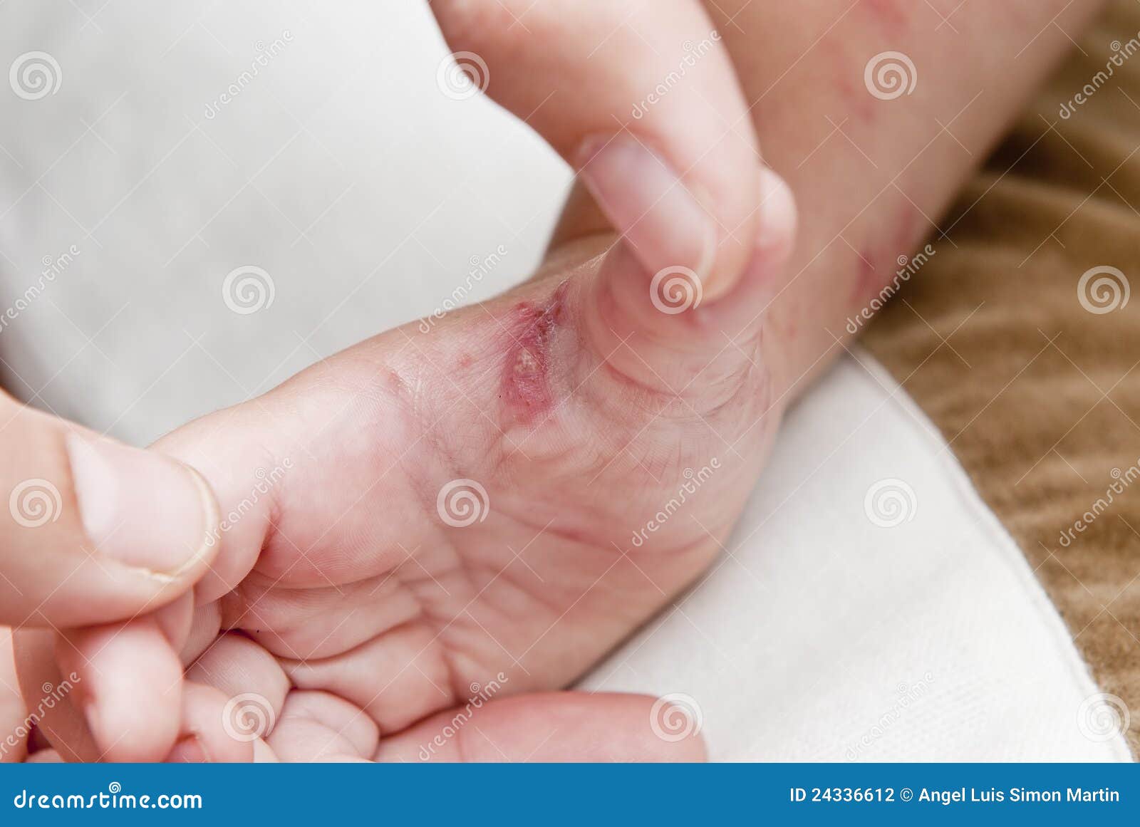 herpes blisters on hand