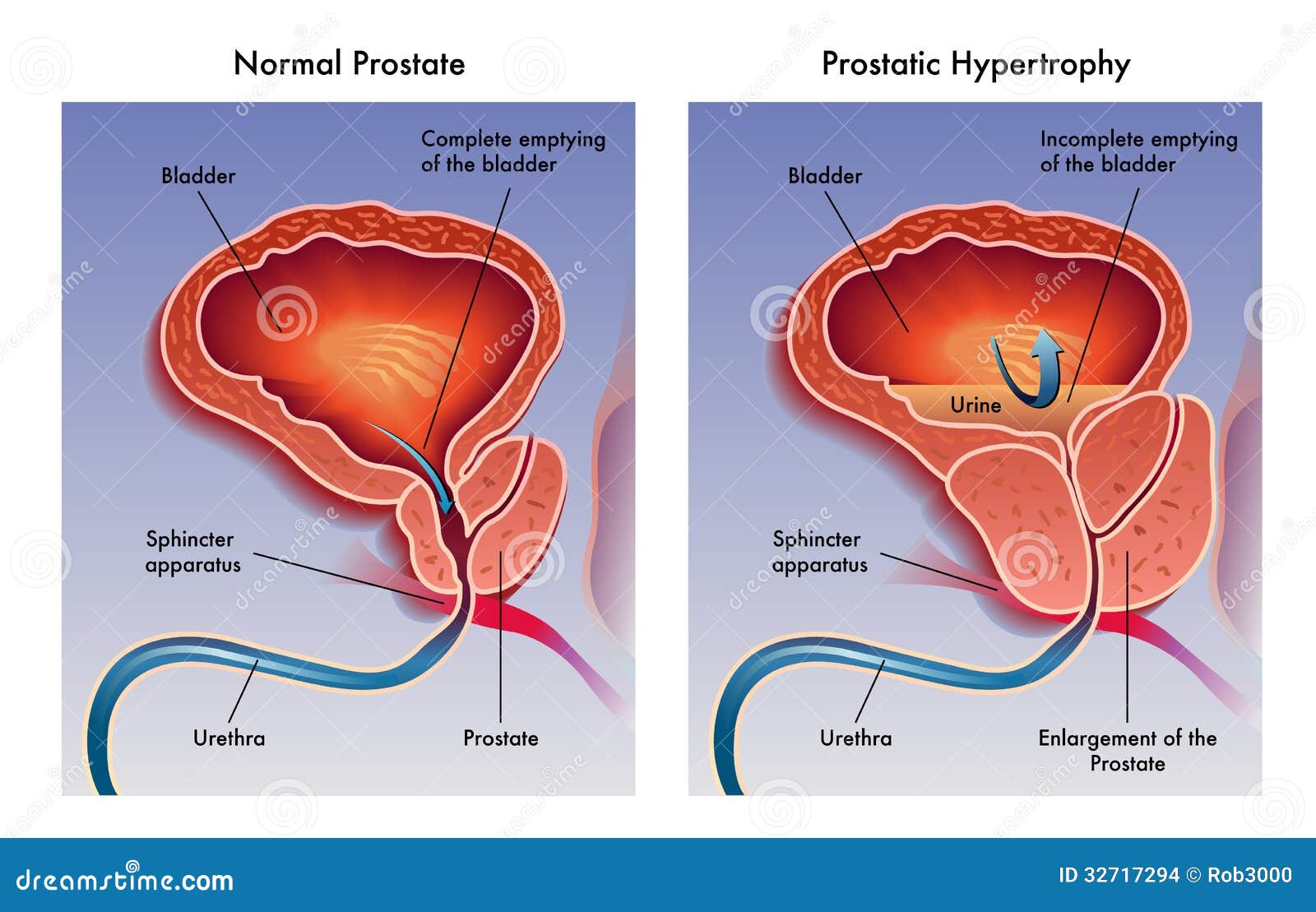 Prostatitis hipertrófia)