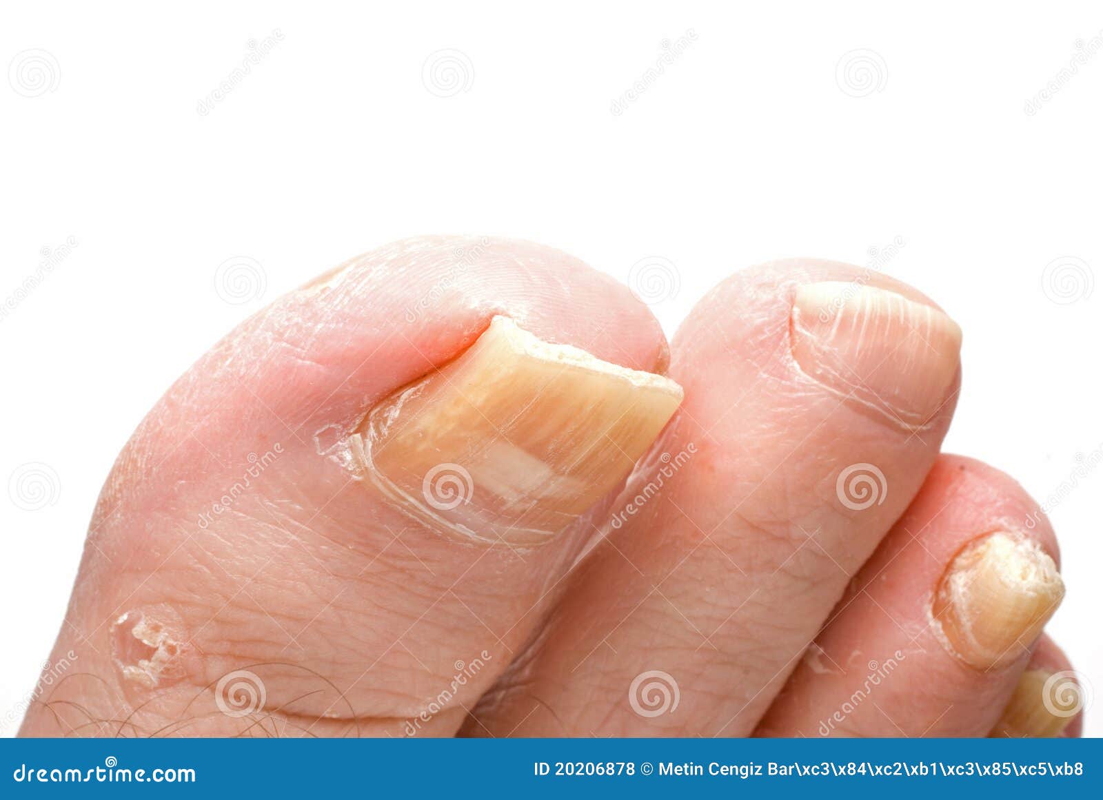 Los hilos del hongo sobre las uñas