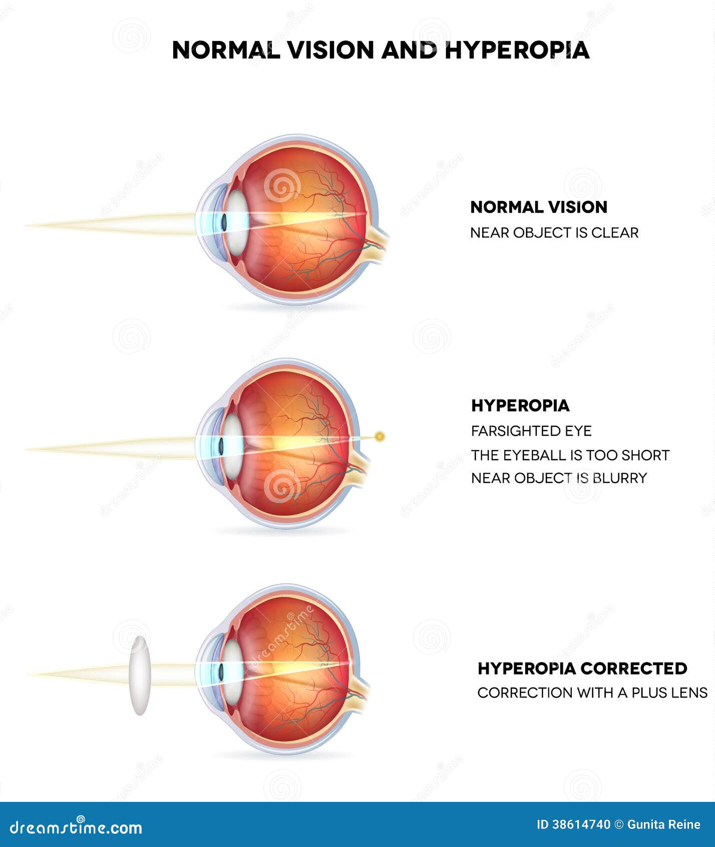 Hyperopia And Normal Vision Stock Photo