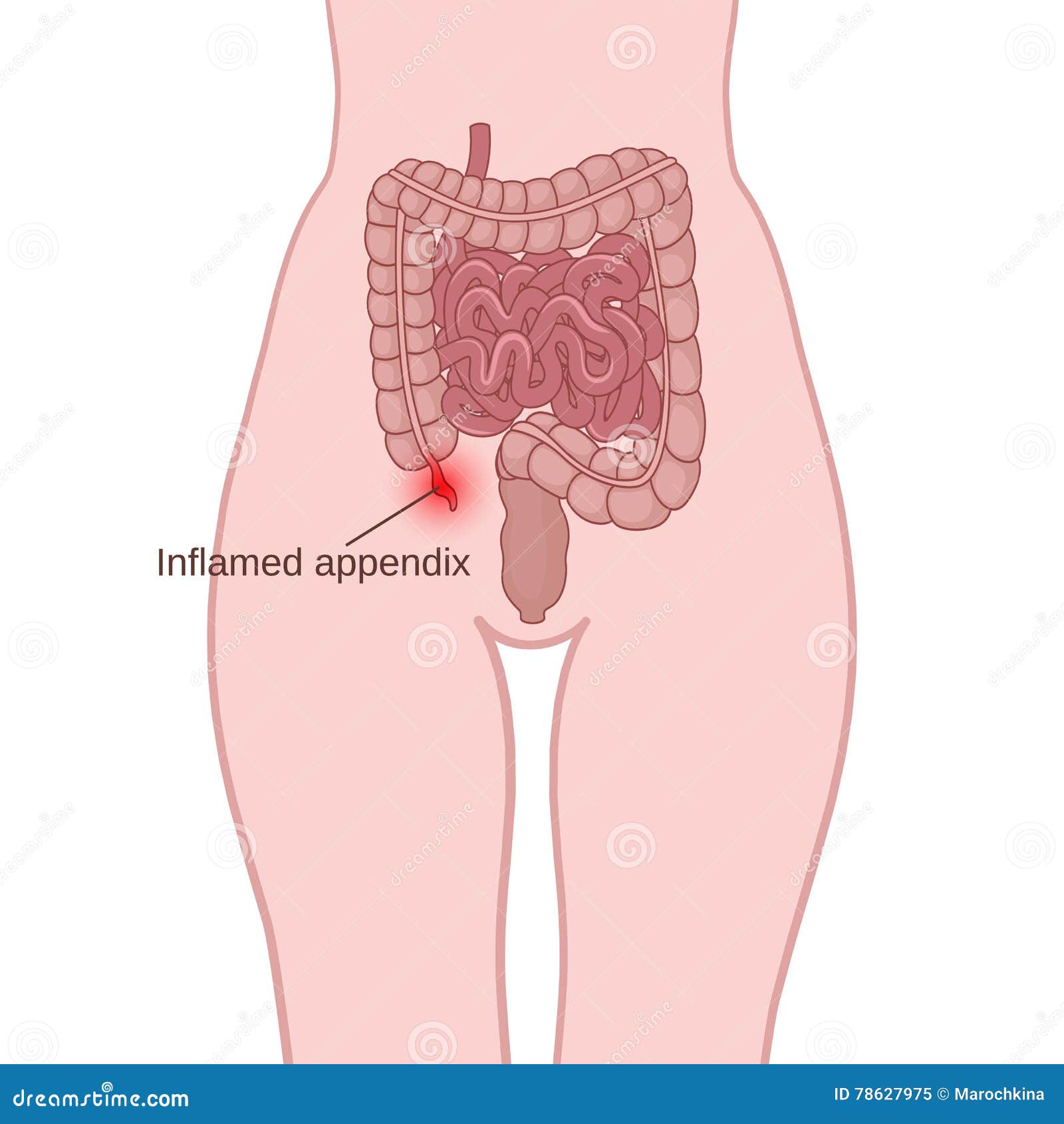 inflammation appendix appendicitis location small large intestine human body 78627975