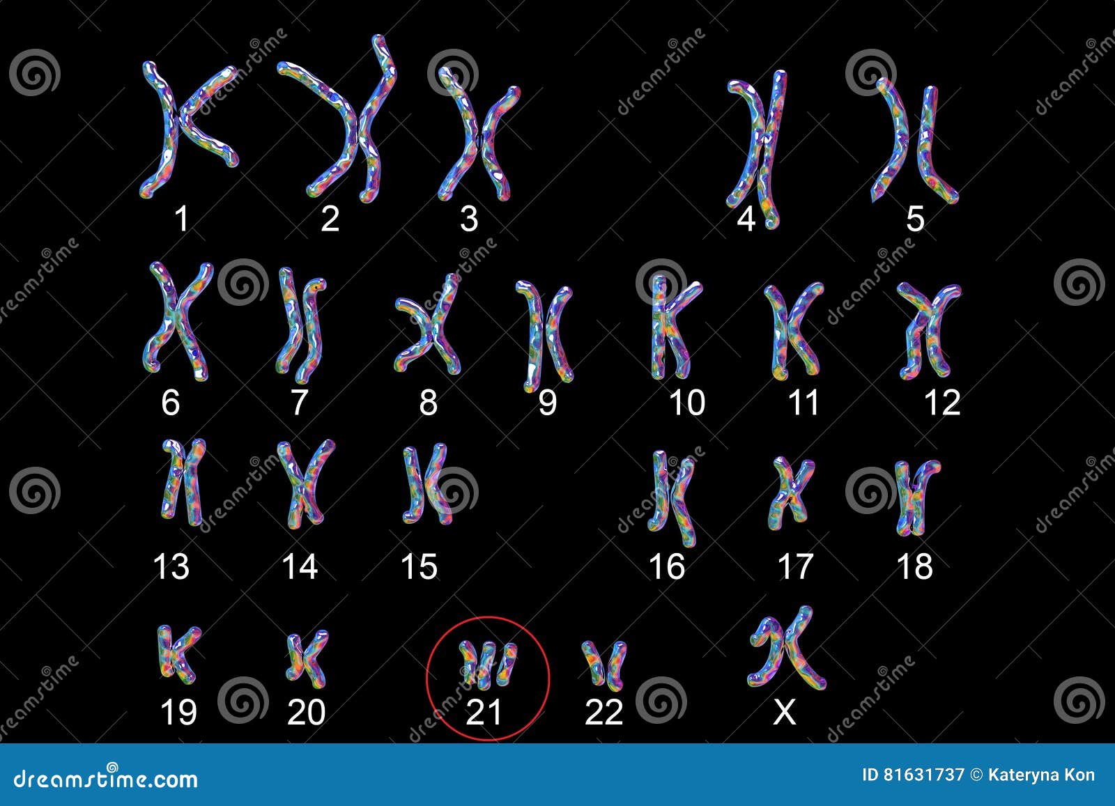 Karyotype De Síndrome De Down Ilustração Stock Ilustração de gene