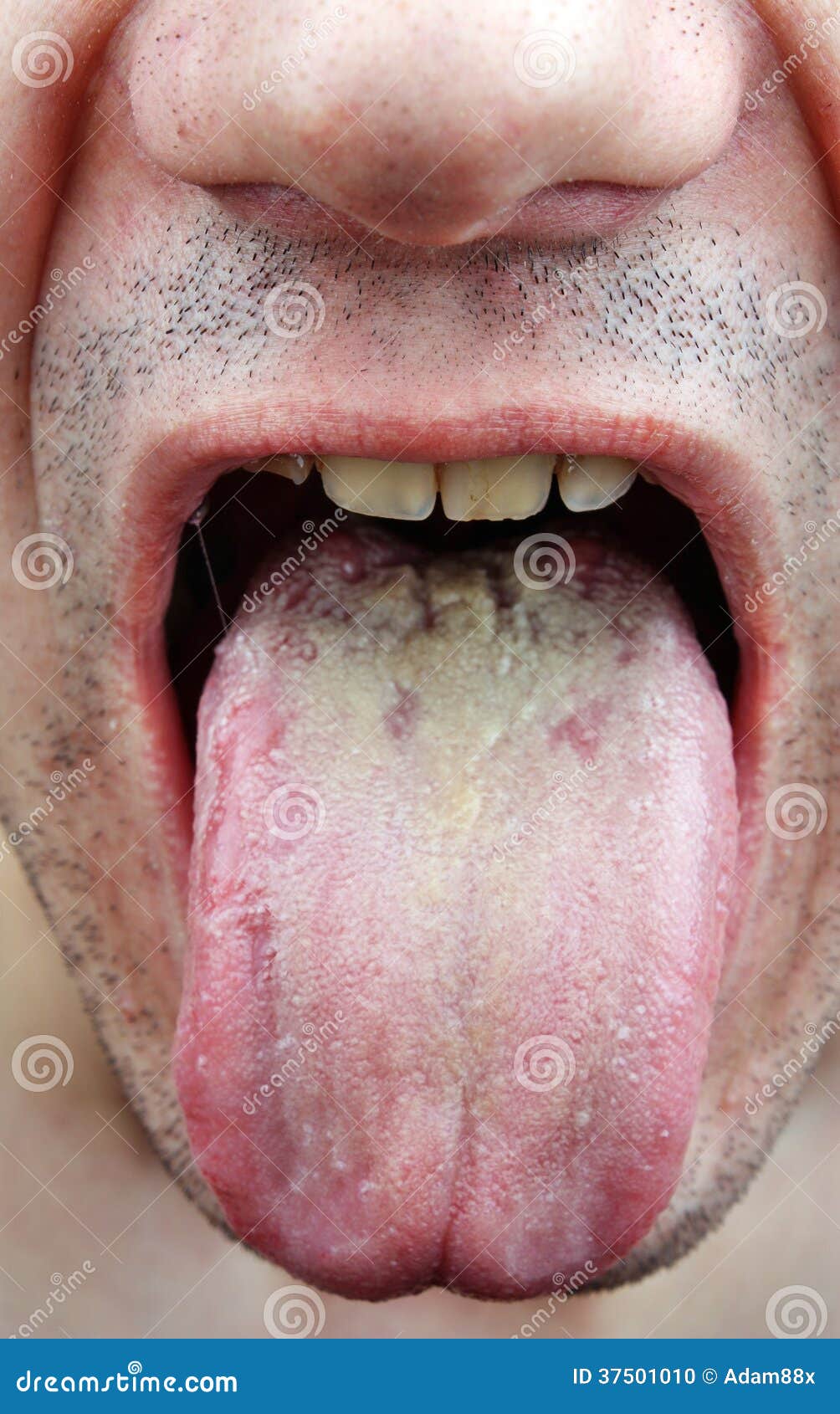 candida albicans behandeling