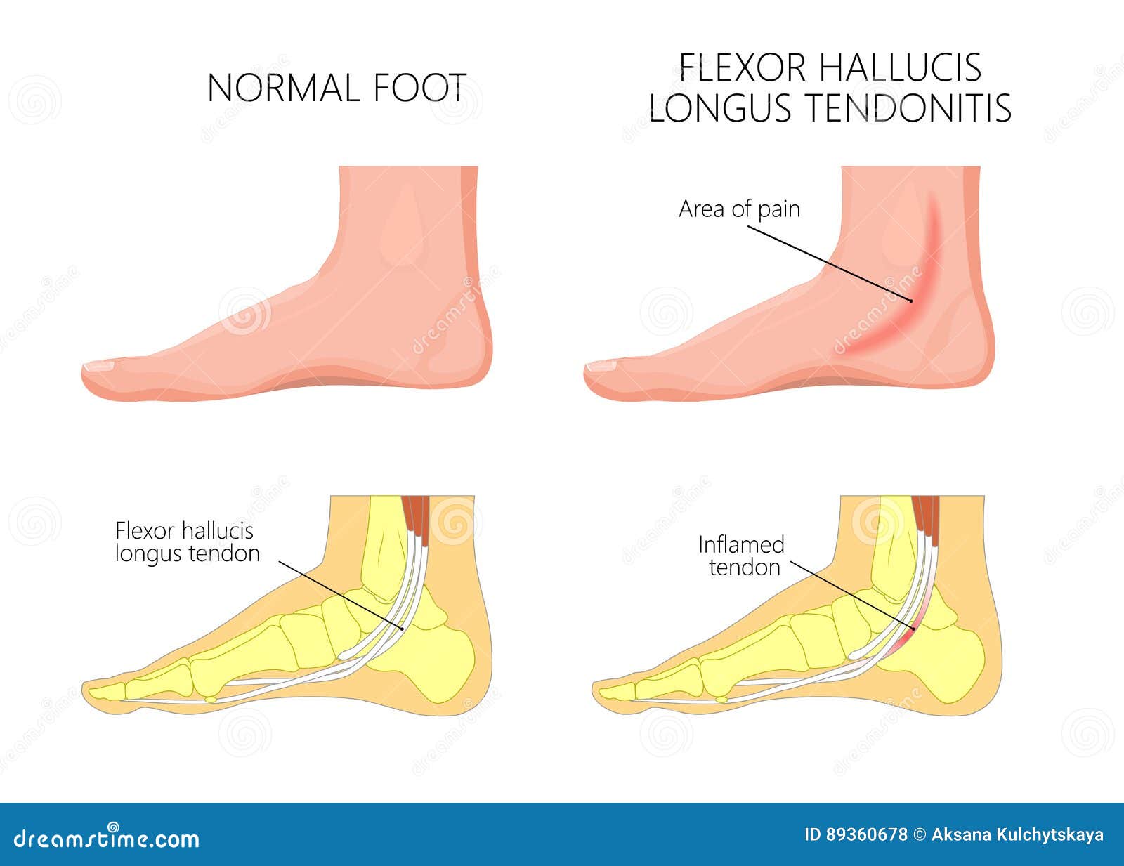 Medial Ankle Injury Posterior Tibial Tendon Dysfunction Vector The Best Porn Website