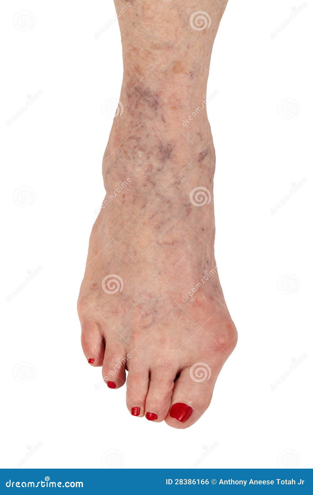 Hammer Toe