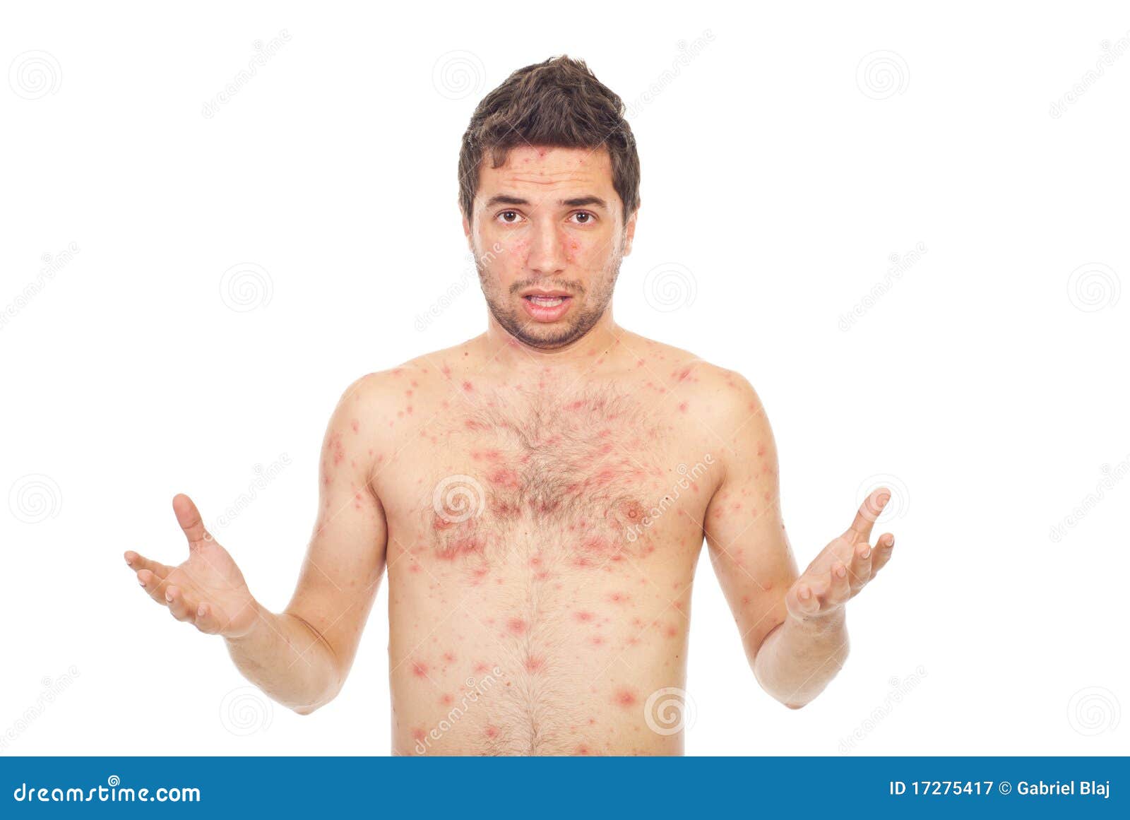 nervous-man-chickenpox-17275417.jpg