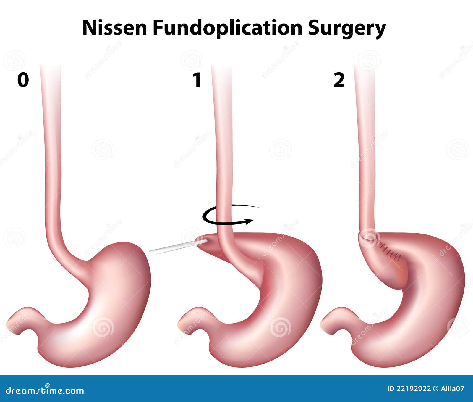 Nissen Fundoplication Surgery used in treatment of heartburn and 