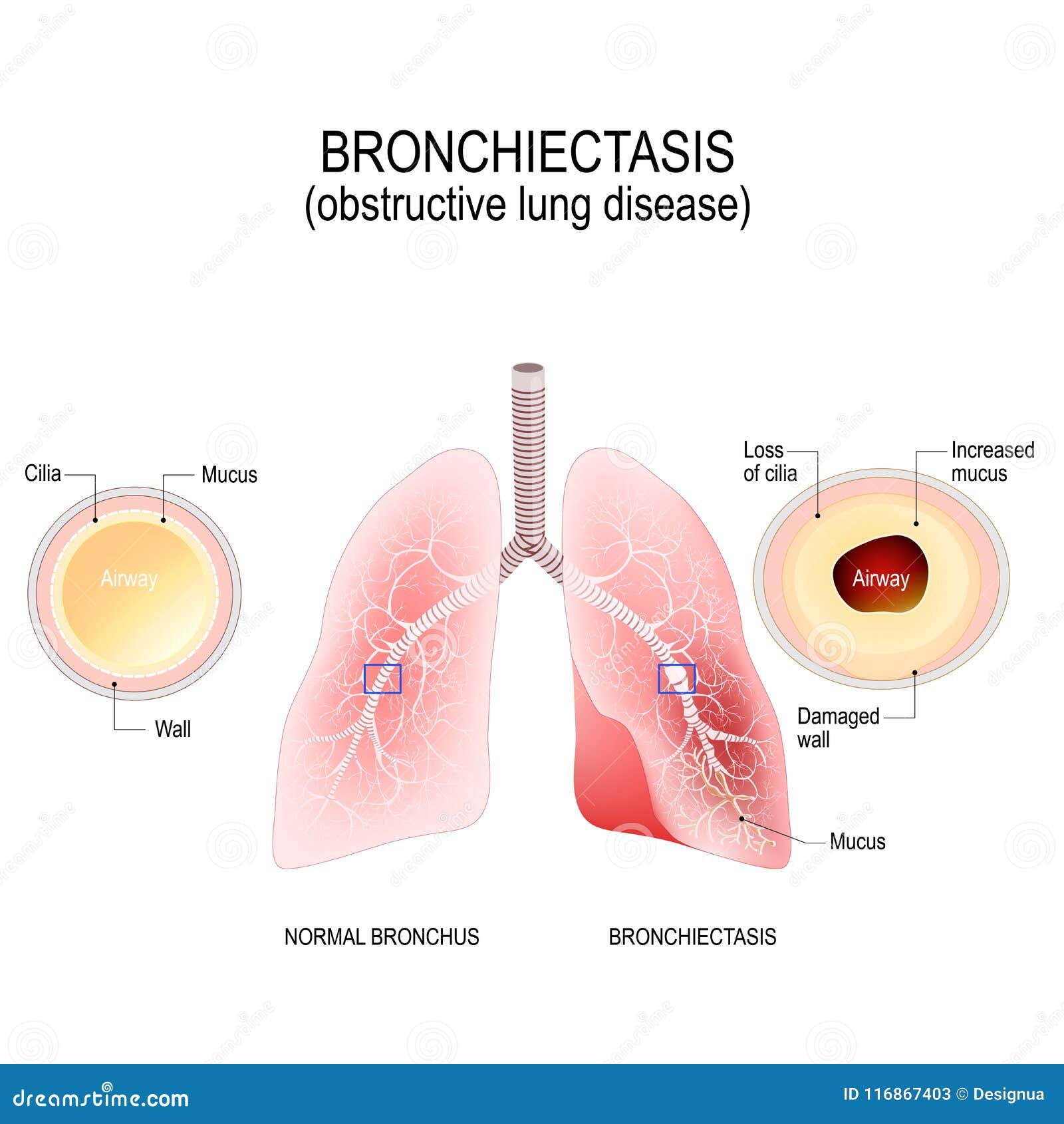 Normal Bronchus And Bronchiectasis Obstructive Lung Disease Stock