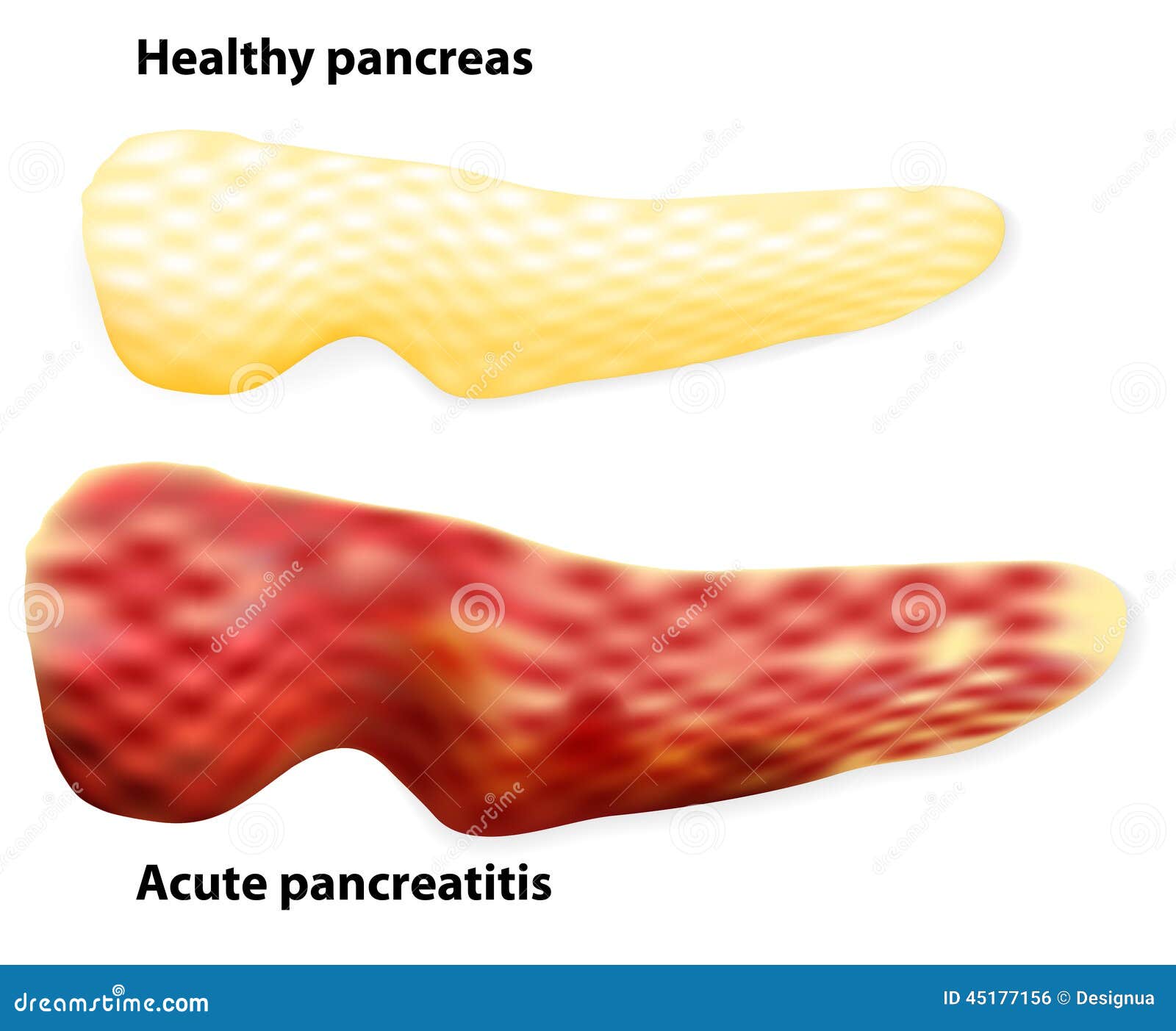 How to keep pancreas healthy naturally