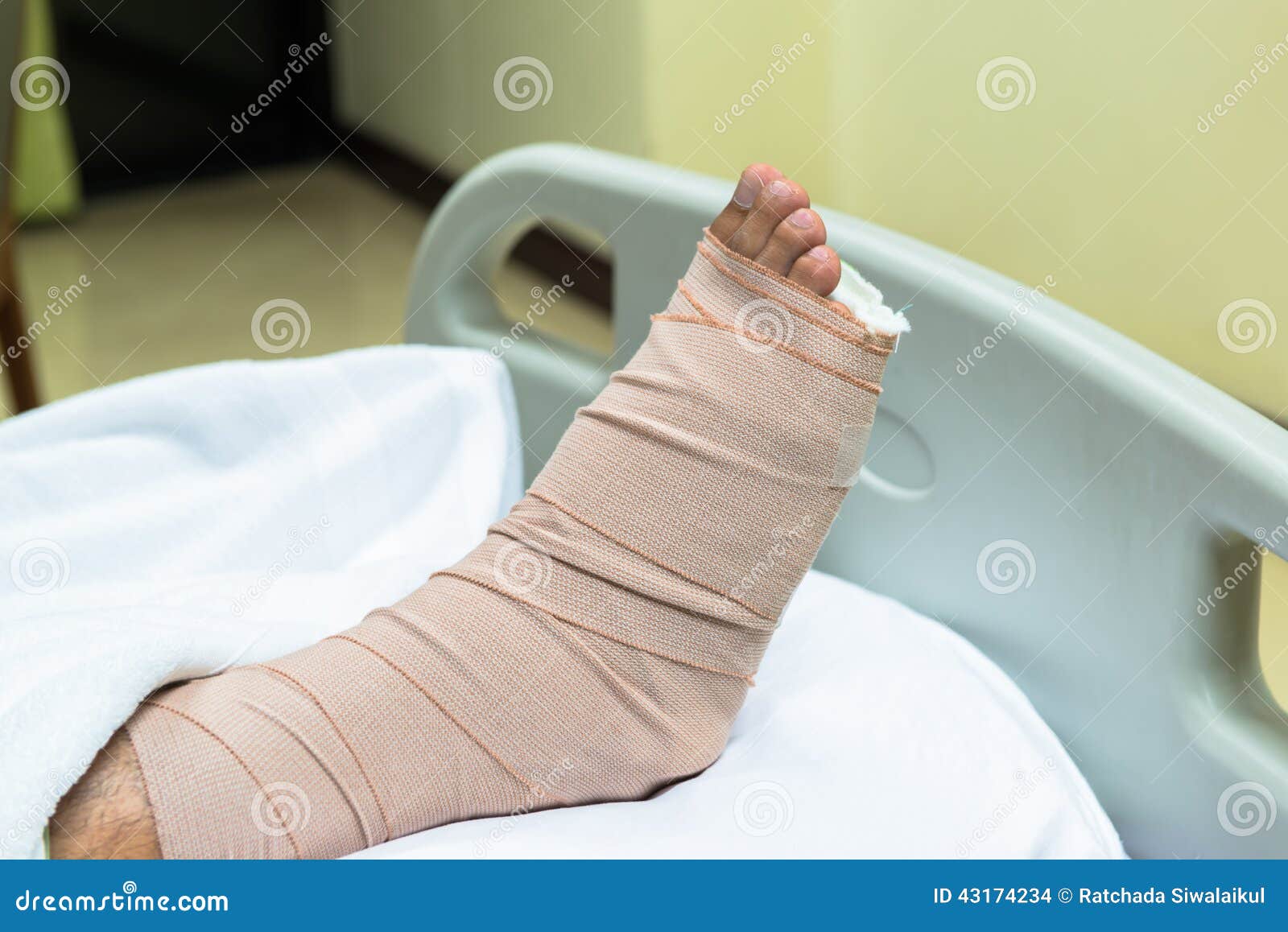 Patient With Broken Leg In Cast And Bandage Stock Photo - Image: 43174234