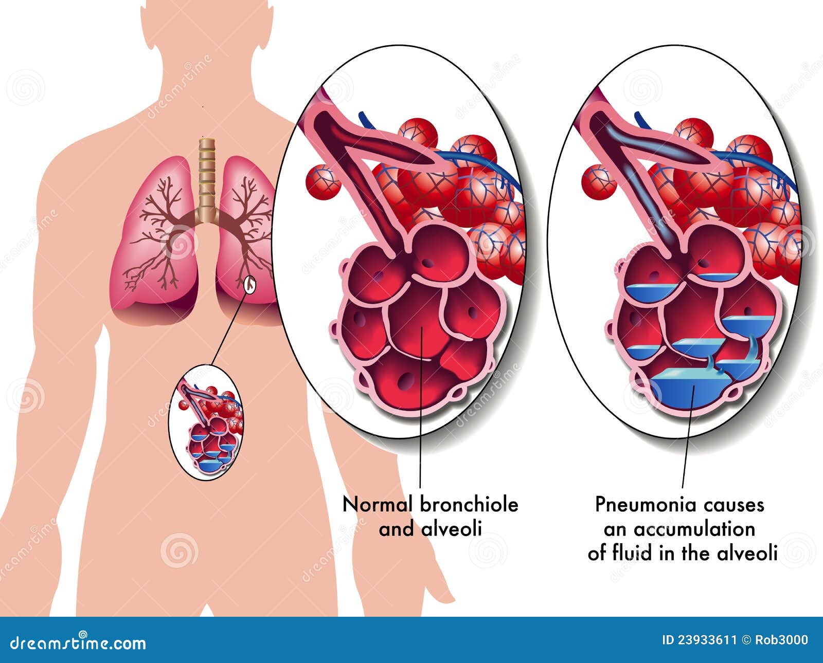 Pneumonia Stock Image - Image: 23933611