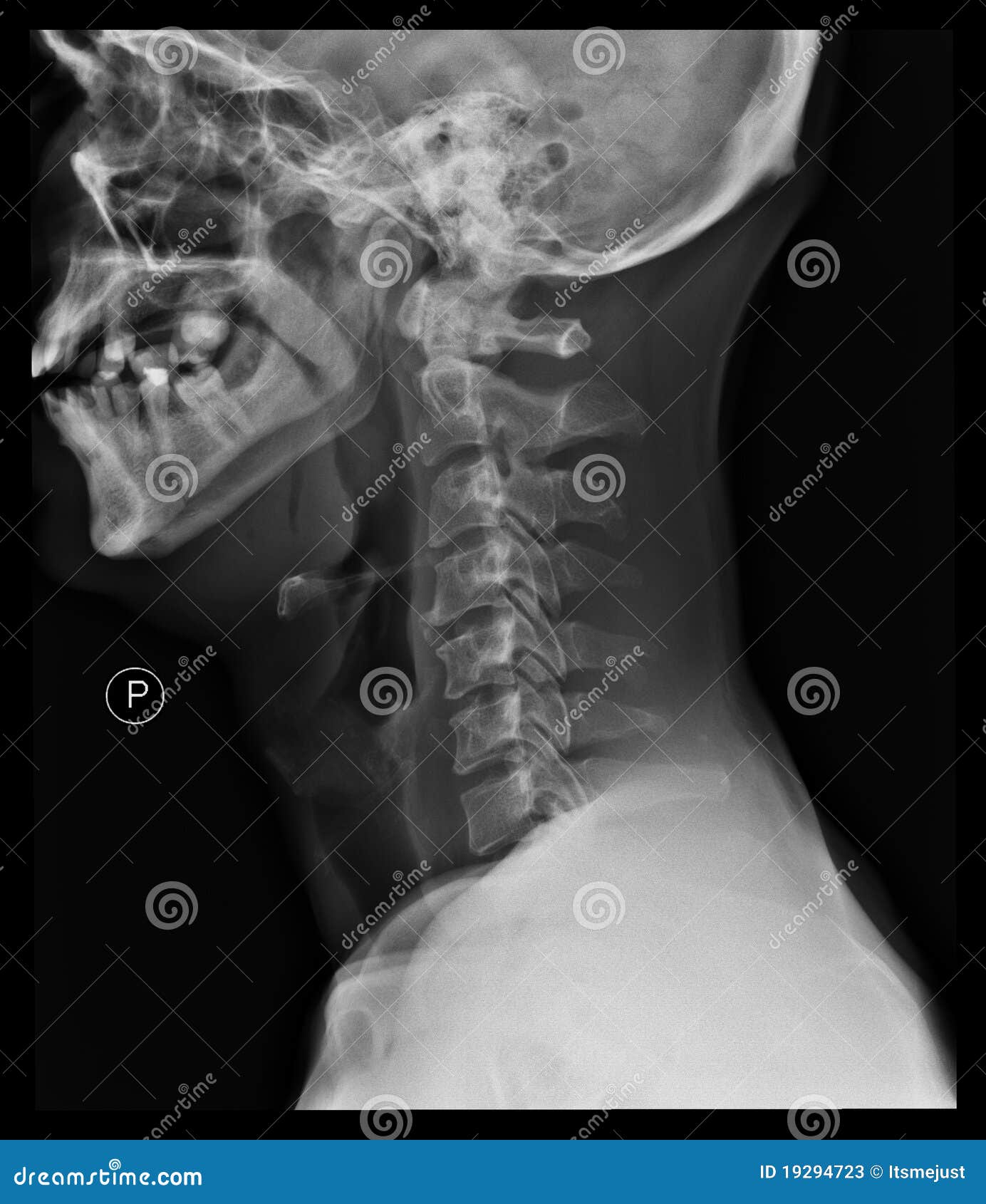 Una vertebra in una vita fa male