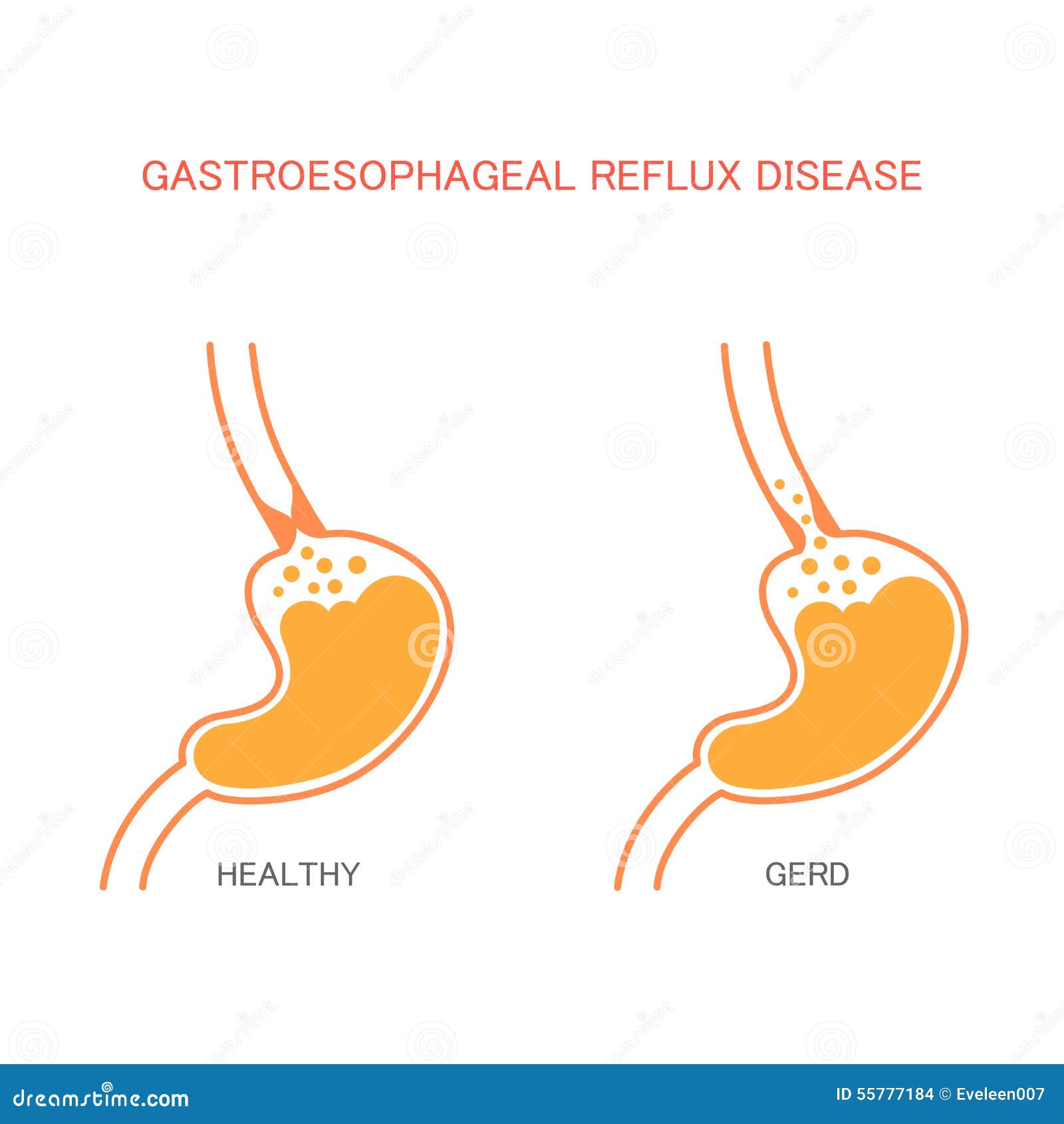 Reflux disease, heartburn, stomach pain, human gastric acid.