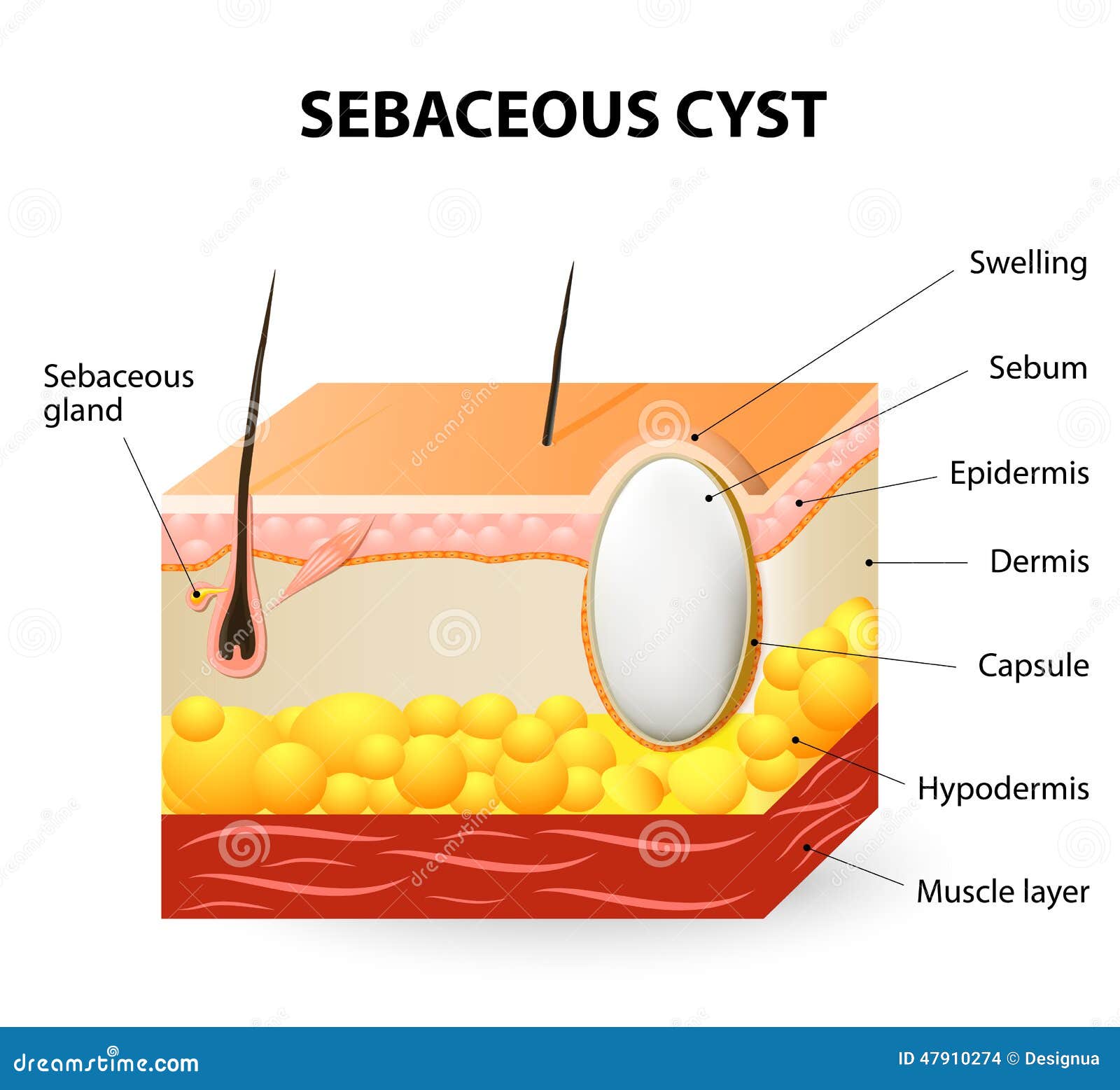 Sebaceous Cyst Or Trichilemmal Cyst Stock Vector