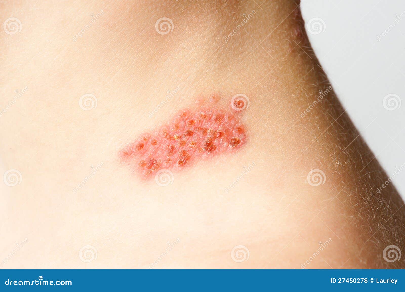 herpes scab pictures