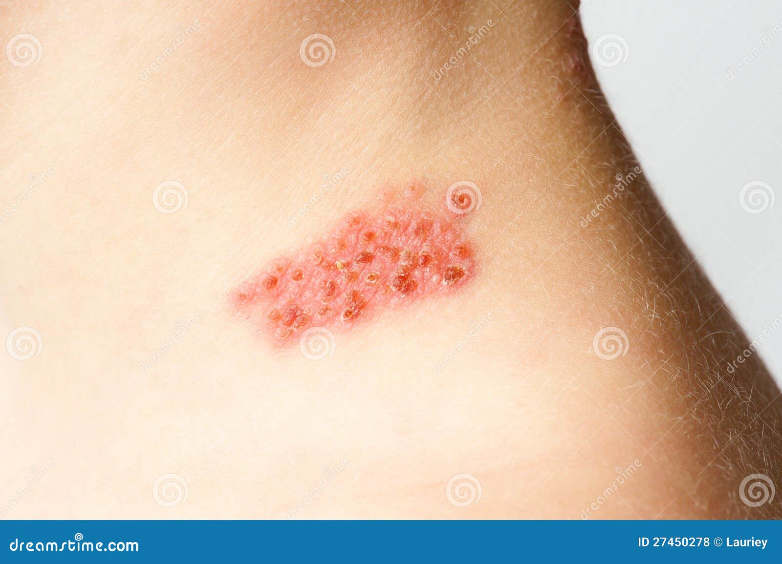 herpes scab