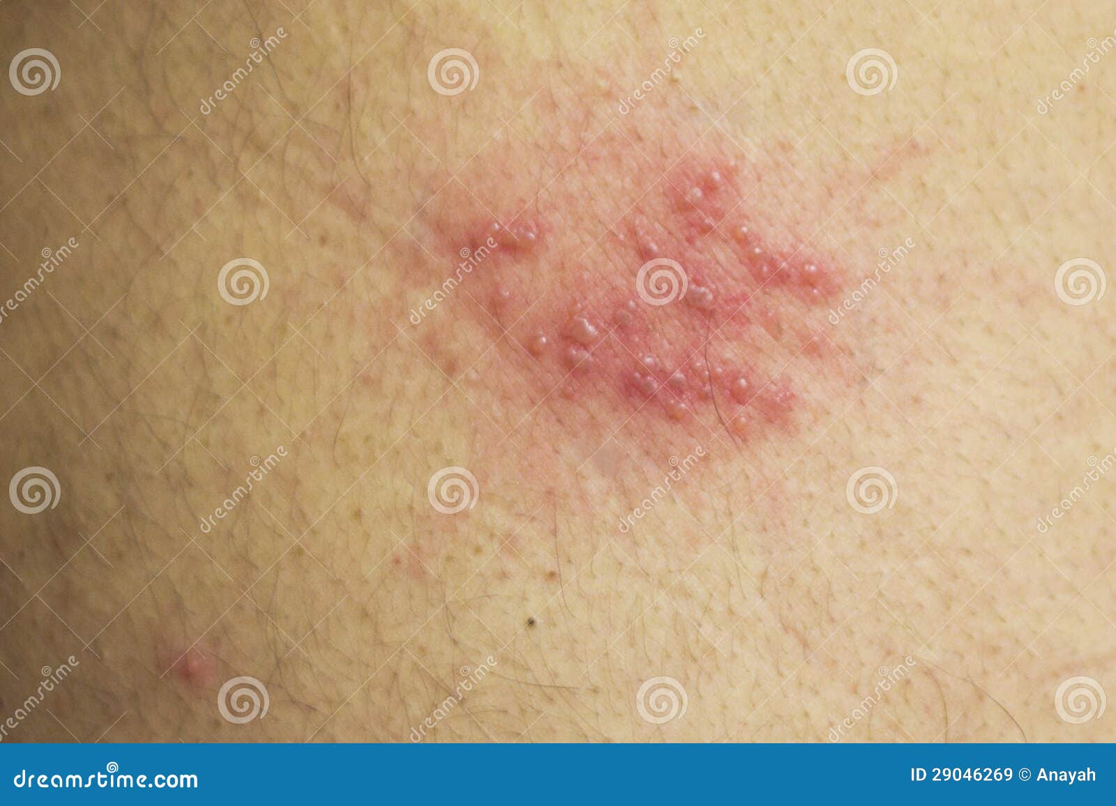 Herpes skin rash | General center | SteadyHealth.com