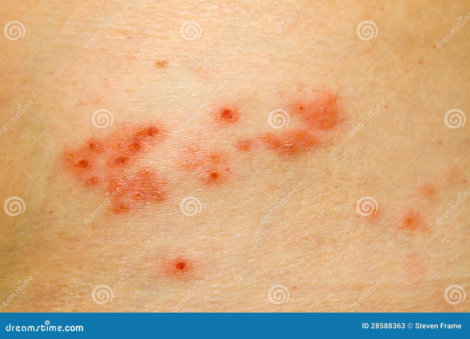 herpes on thigh picture #10
