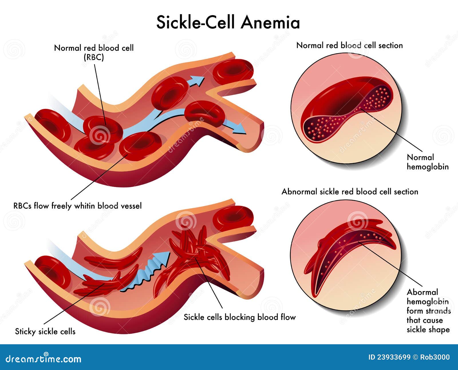 The Disease Process Of Sickle Cell Anemia