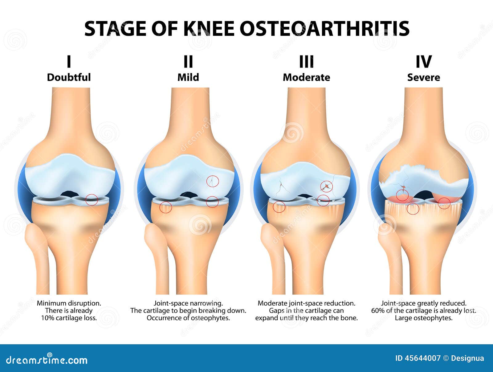 Stages Of Knee Osteoarthritis Oa Stock Vector Image 45644007