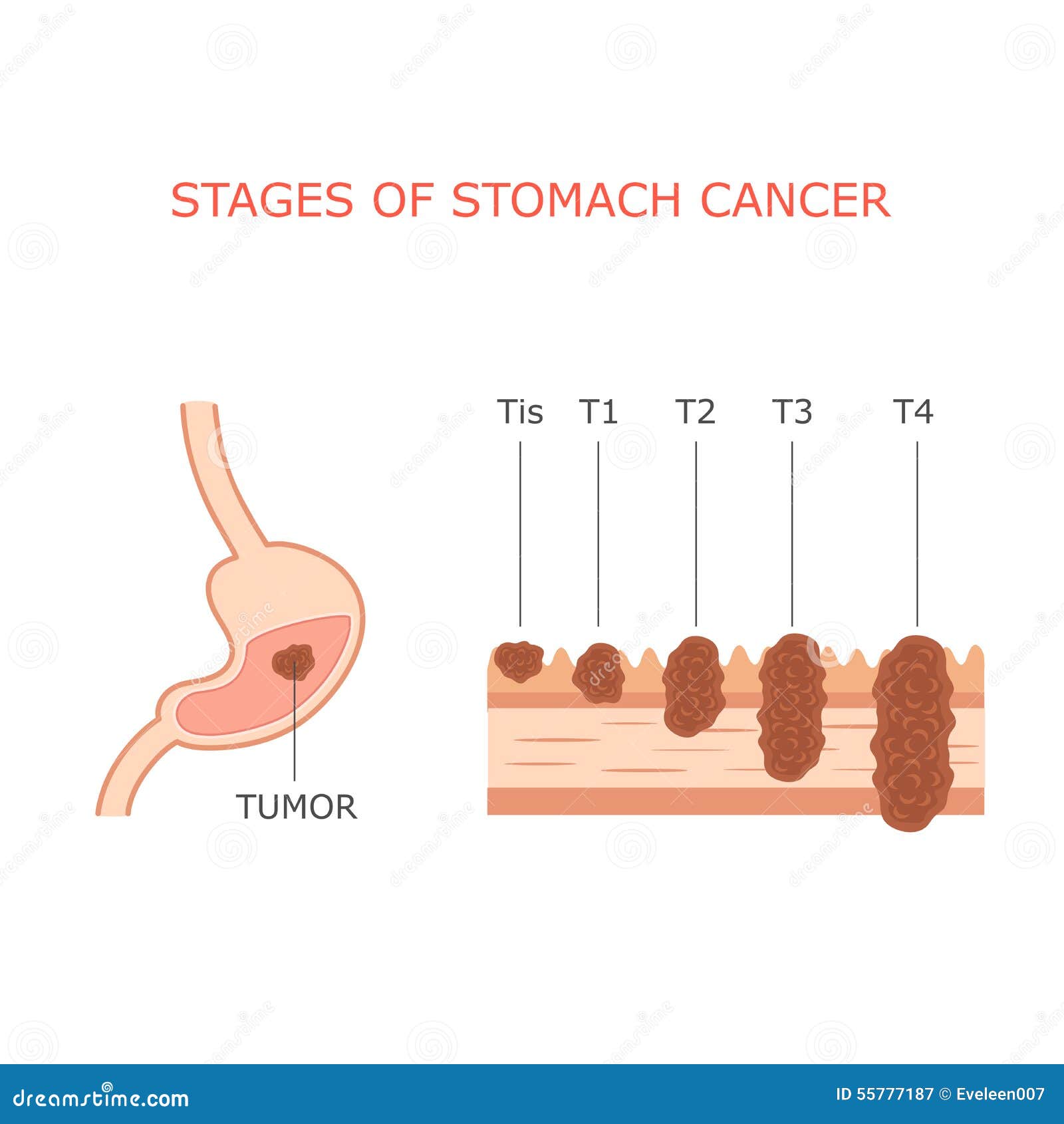 main causes of stomach cancer