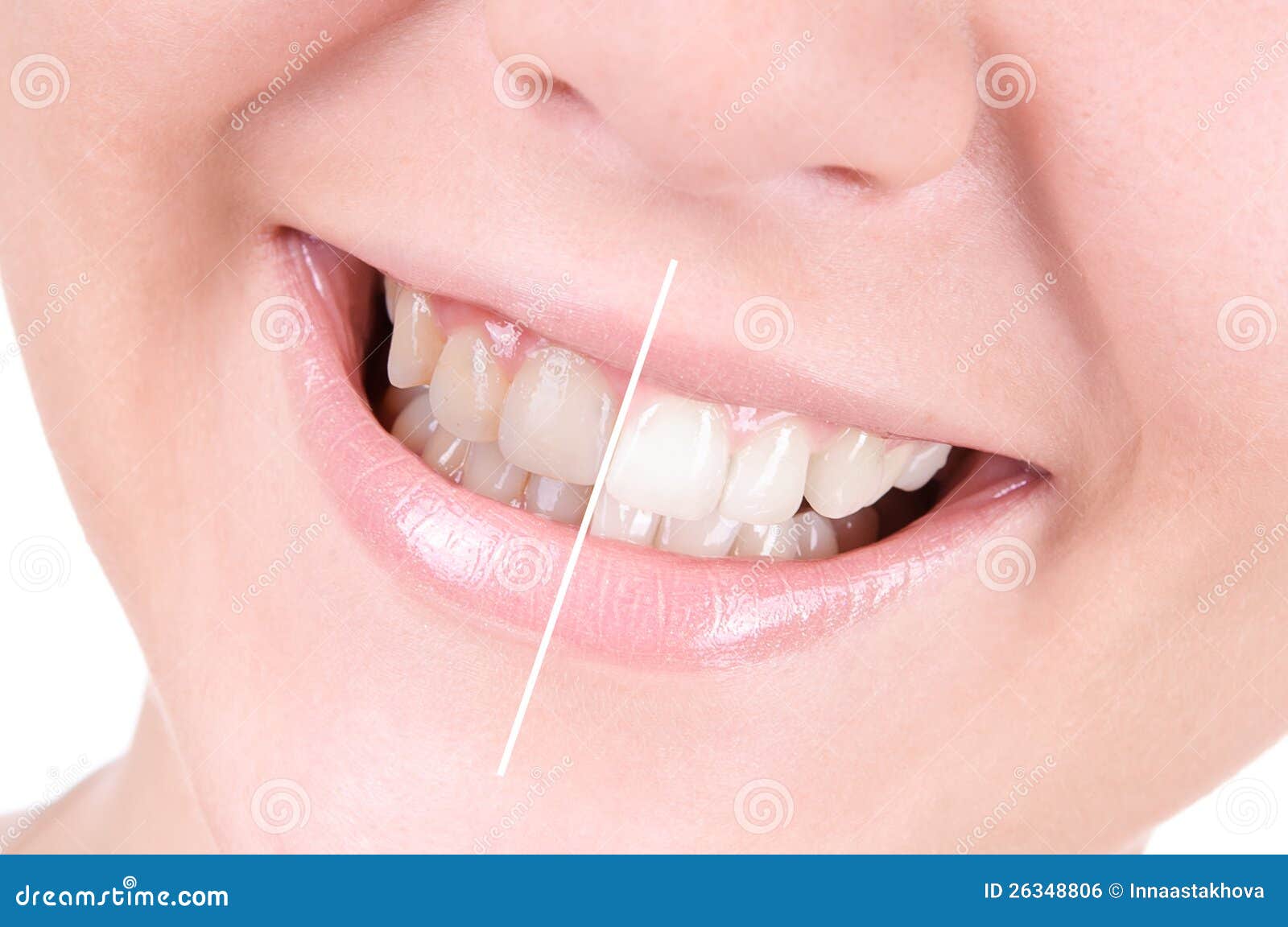 teeth-whitening-dental-care-26348806.jpg