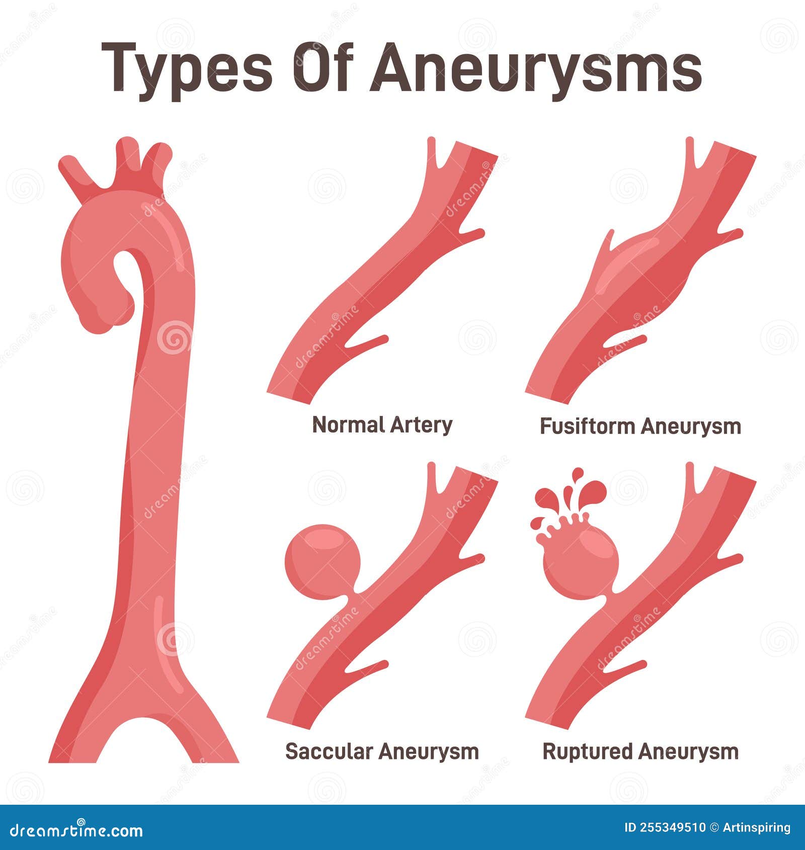 Thoracoabdominal Aortic Aneurysms Types Healthy Aorta And Aorta Vector