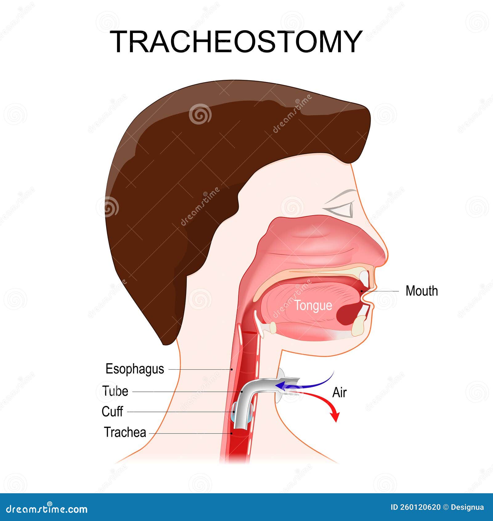Tracheotomy Side View Of The Neck And The Correct Placement Of A