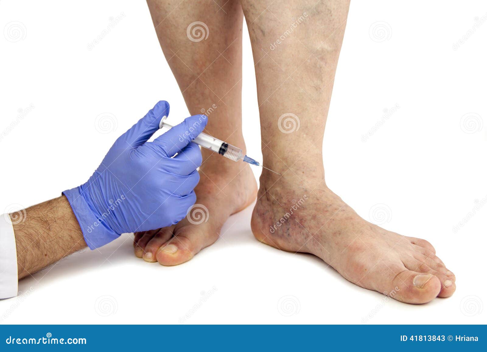 Come varicosity in un utero influenza la gravidanza