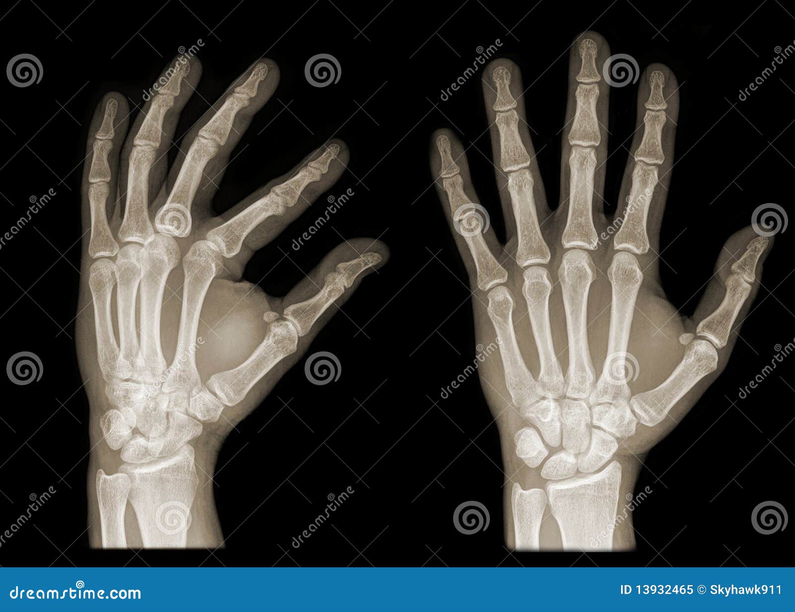 hand x ray clipart - photo #32