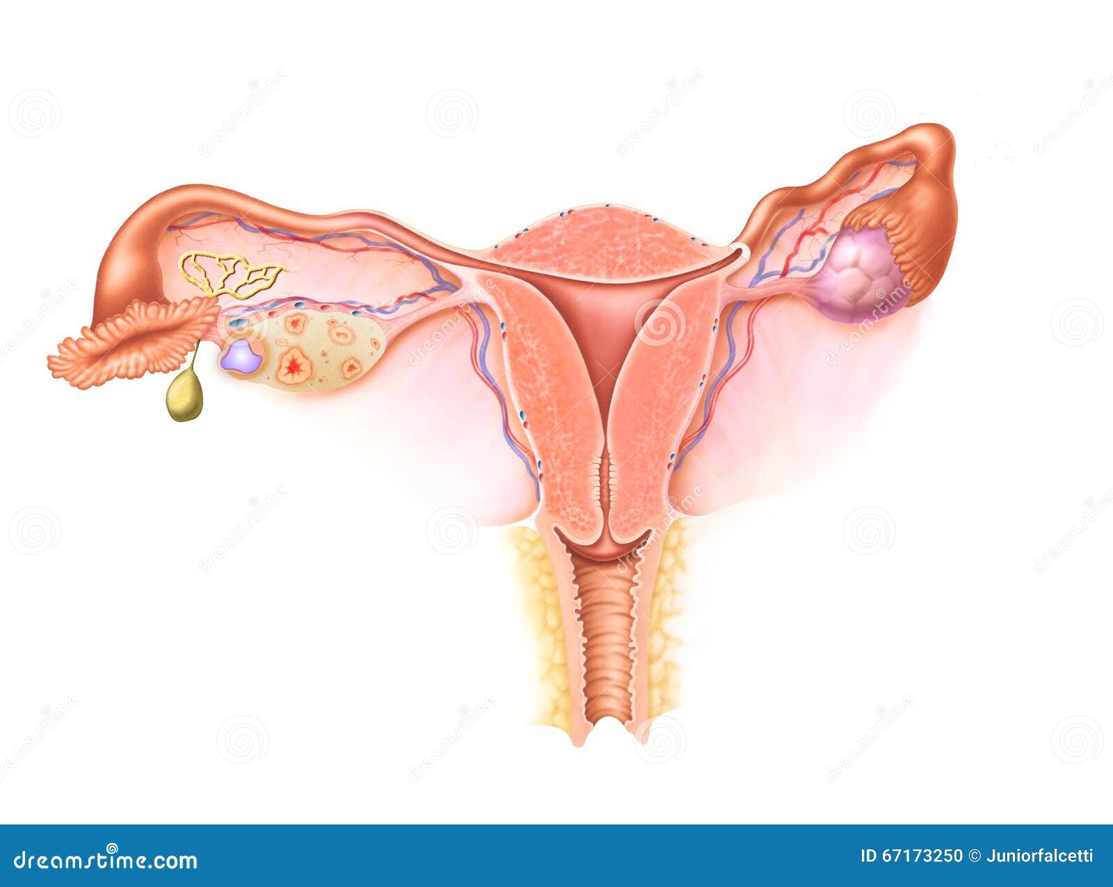 Treatment of early cervical cancer most cancers cervical polyps