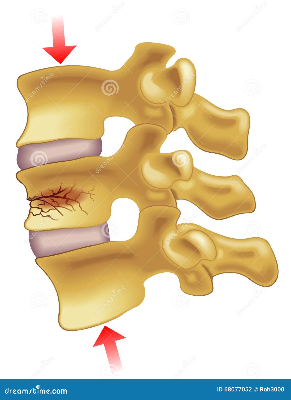 Vertebral Compression Fracture Stock Vector - Image: 68077052