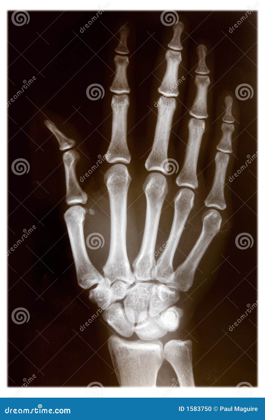 hand x ray clipart - photo #21