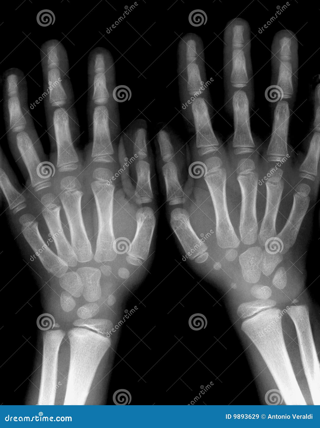 Xray Hands Royalty Free Stock Images Image 9893629