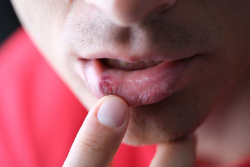 Herpes On Nipple Picture