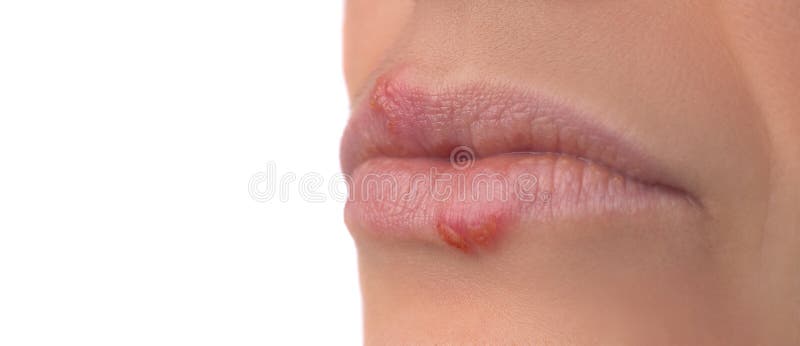 Herpes On Nipple Picture