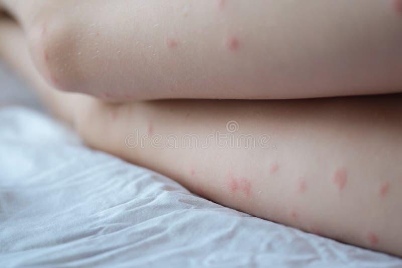 éruption Rouge Sur La Peau Blanche Des Boutons De Jambes Femelles ...