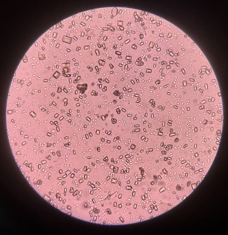 Urine crystals eClinpath